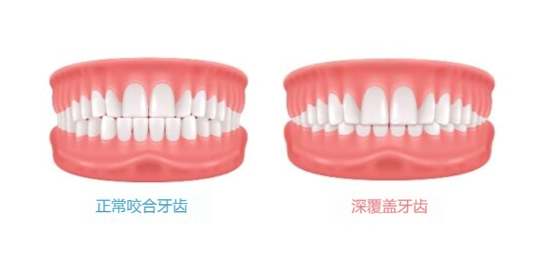 牙齿咬合正常图解:你的牙齿咬合是"黄金三角洲"还是"地形灾害区"?
