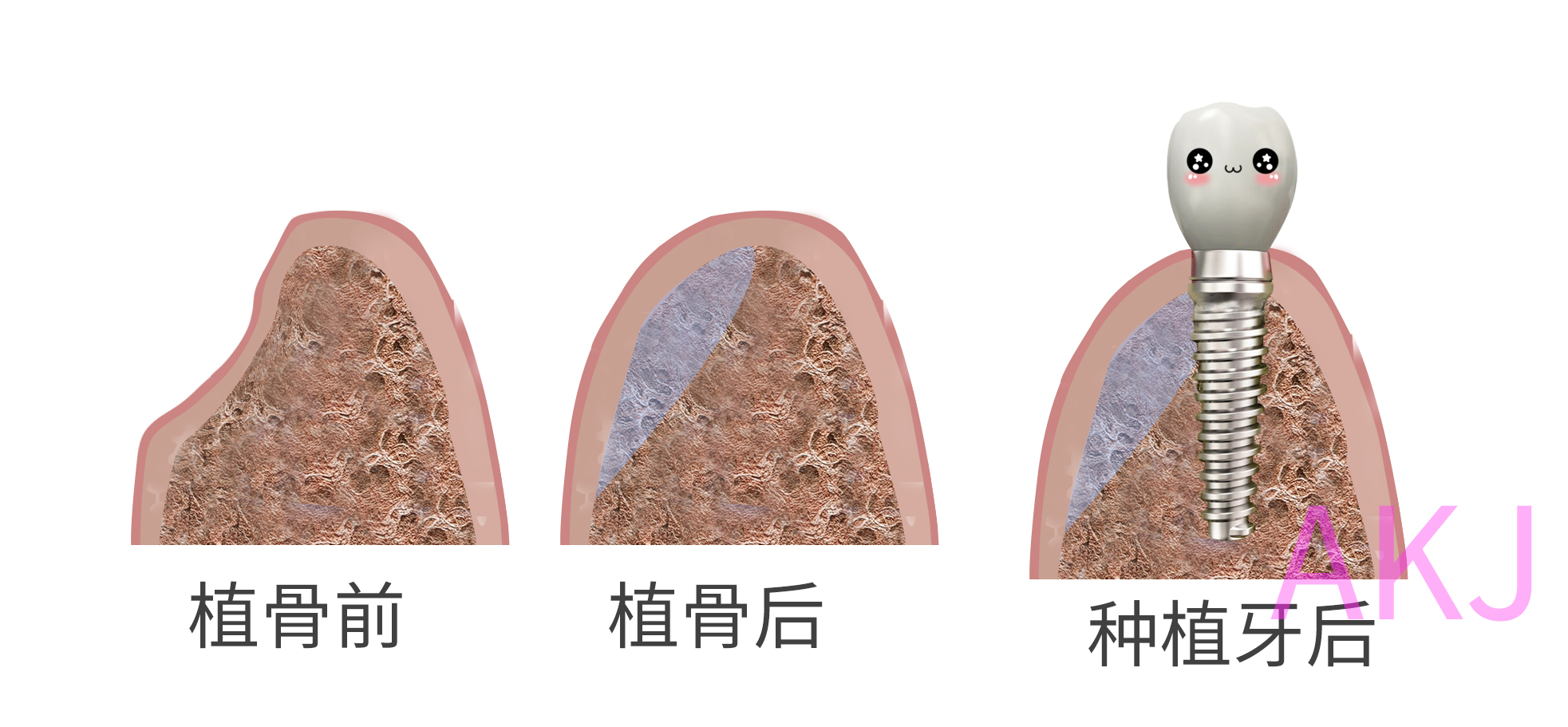 哪些情况不适合做种植牙？看看这三种情况