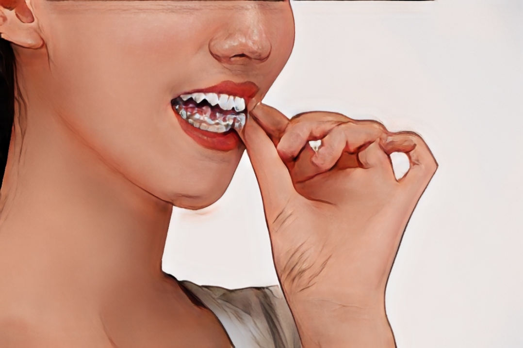 戴隐适美矫正牙齿对怀孕有影响吗？深圳口腔医师支招孕期科学护齿