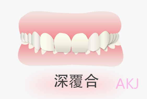 深圳牙科深覆合牙齿矫正前后对比 | 深覆合矫正模拟案例解析
