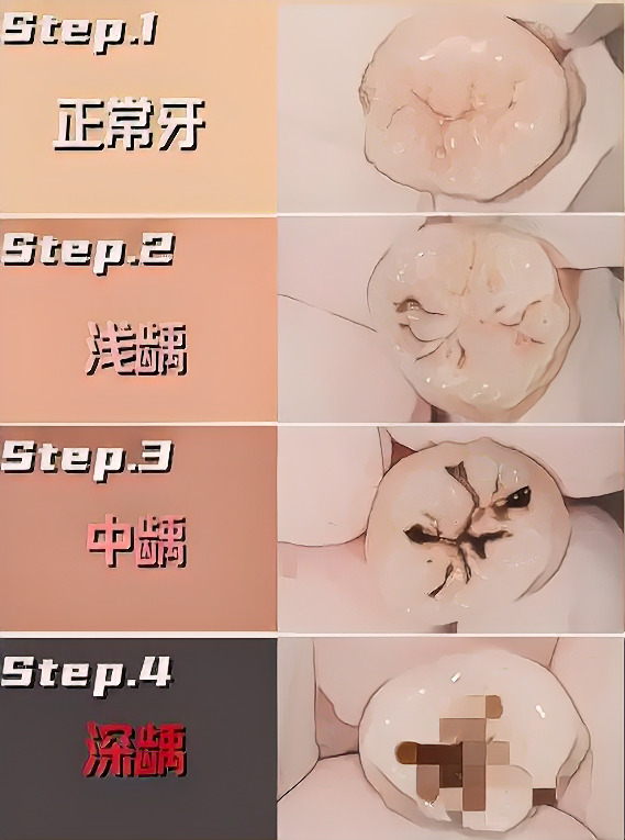 蛀牙到什么程度必须看医生？一文看懂龋齿治疗时机，别再拖了！