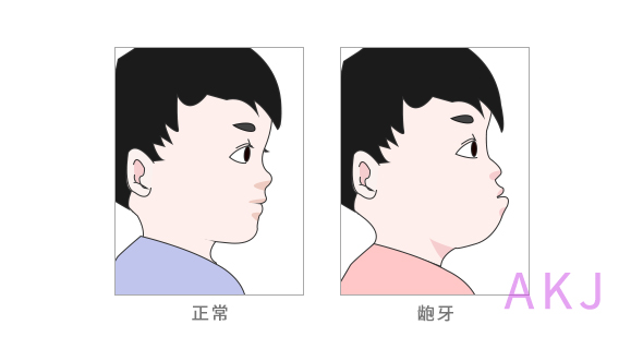 小孩遗传性骨性龅牙怎么办