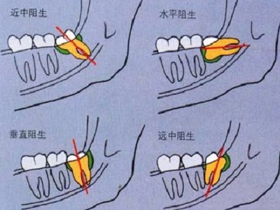 拔阻生智齿有几种拔牙方法？一篇说清4种常见拔智齿方案，看完不再慌